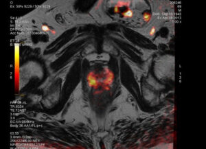 Cancer De Prostate Centre D Urologie Paris Essonne